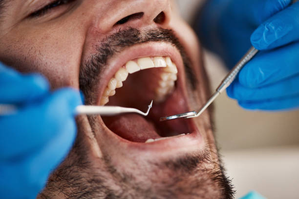 Best Emergency Treatment for Dental Infections or Abscesses in Folly Beach, SC