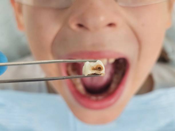 Best Emergency Tooth Extraction in Folly Beach, SC